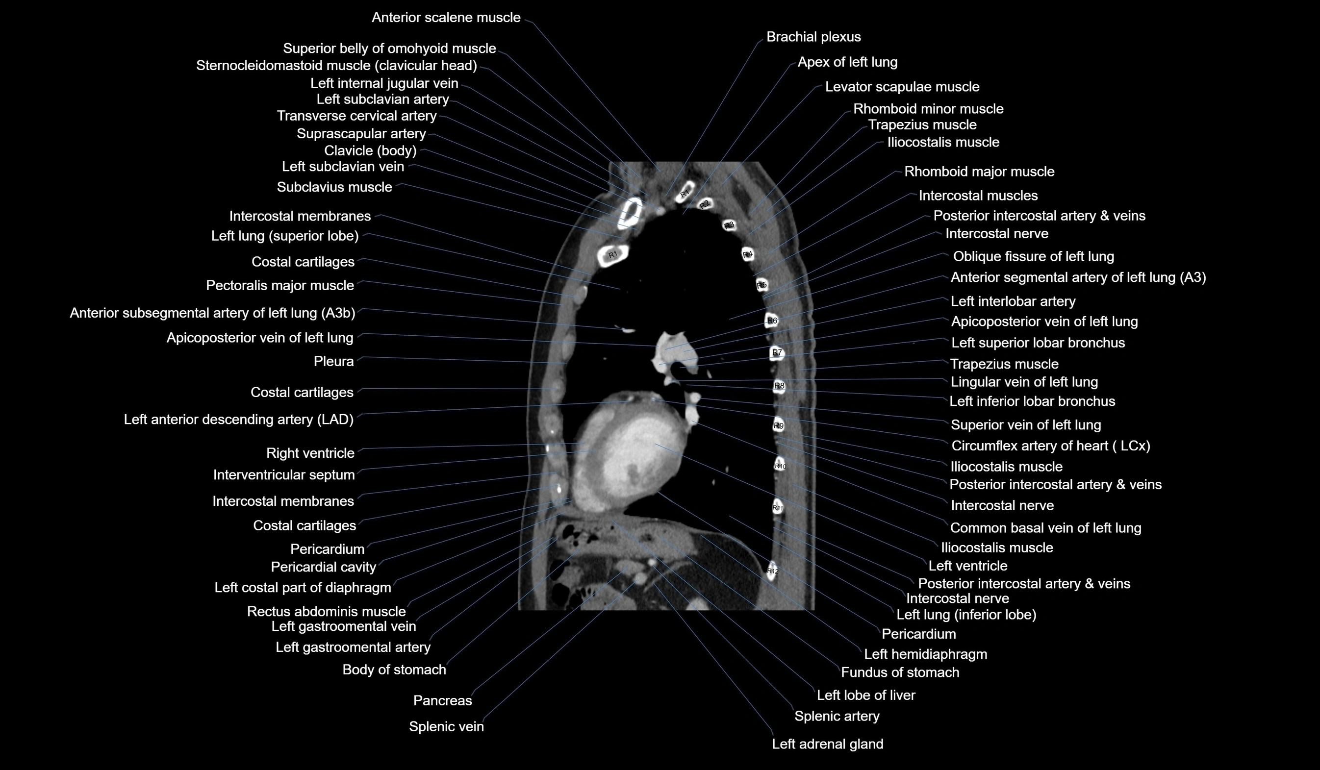 CT chest (thorax) soft tissue window labelled sagittal cross sectional anatomy radiology image-00091.webp